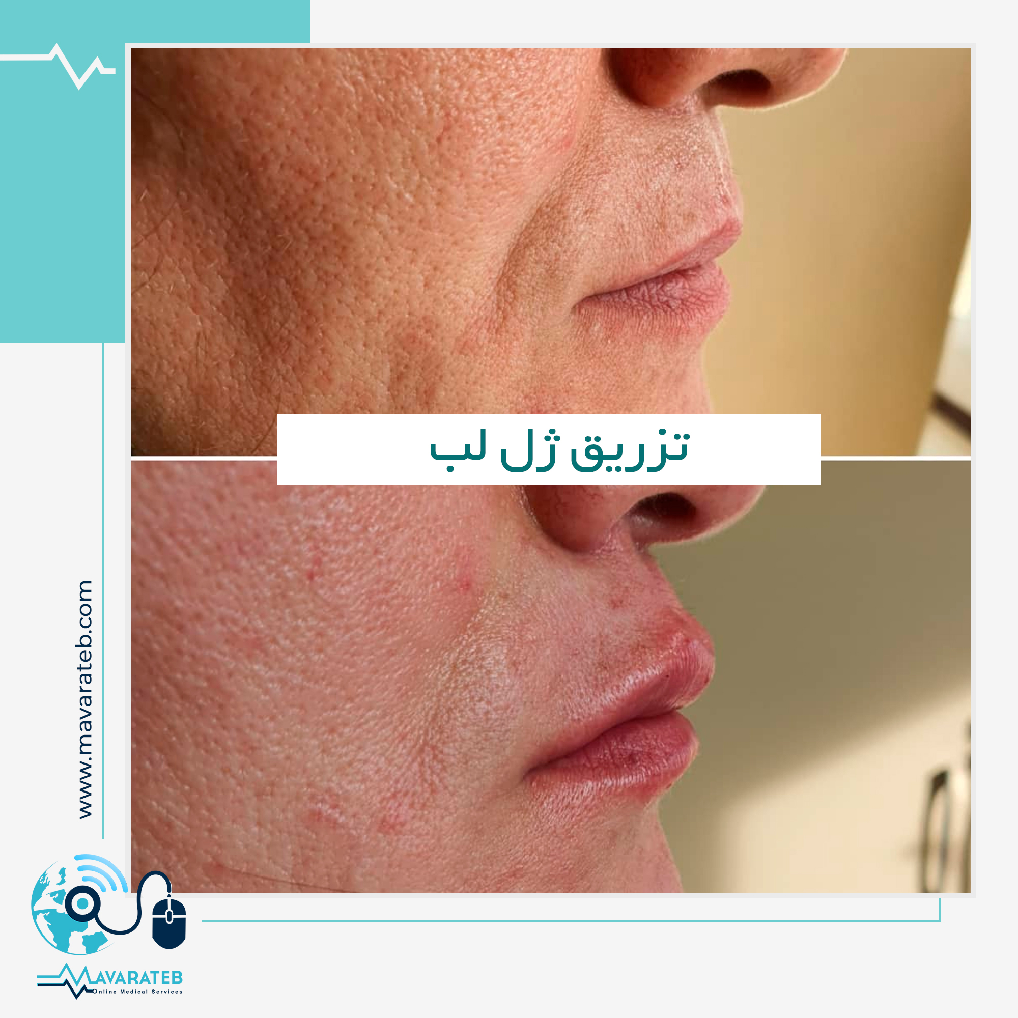 نمونه کار تزریق ژل لب