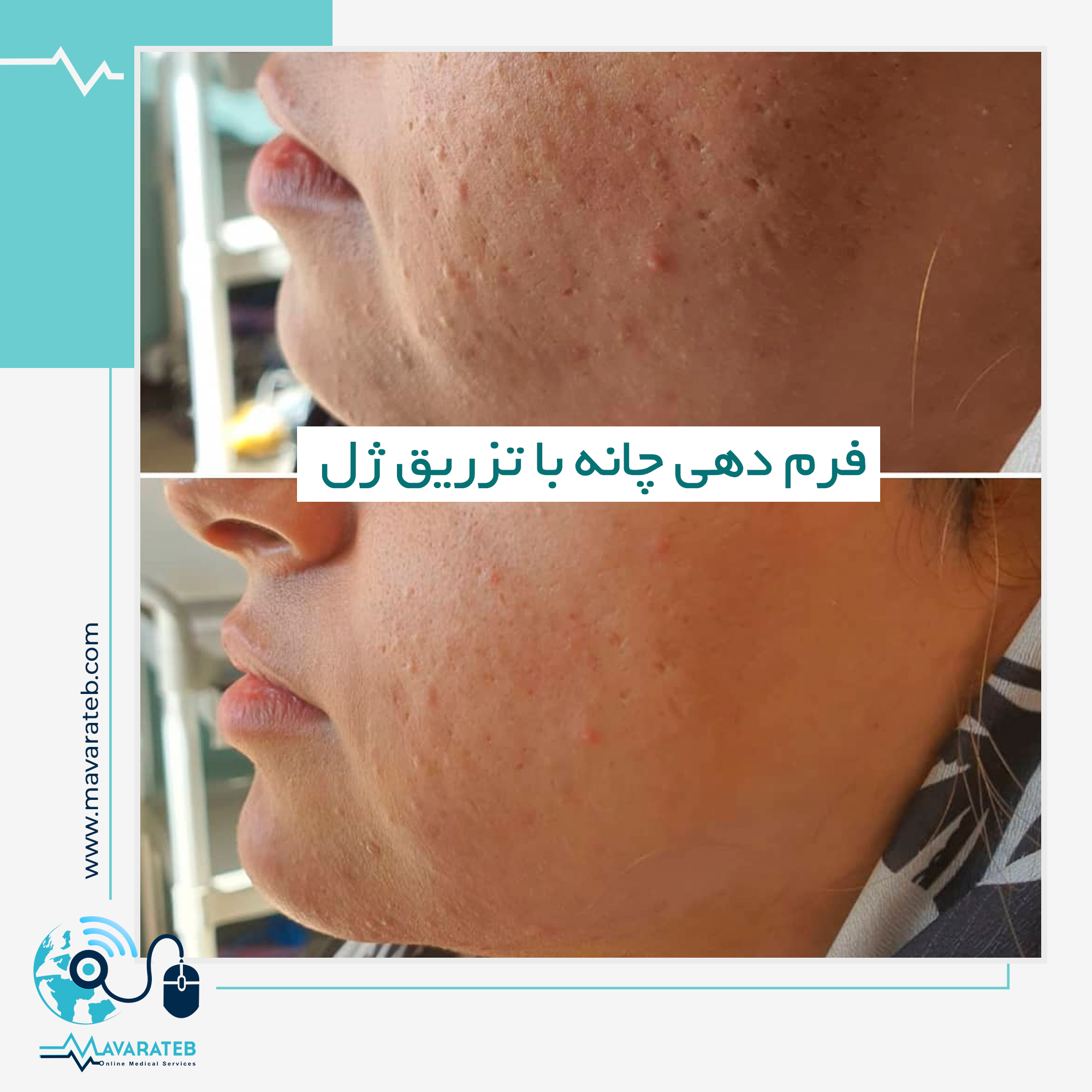 نمونه زاویه سازی فک با تزریق ژل