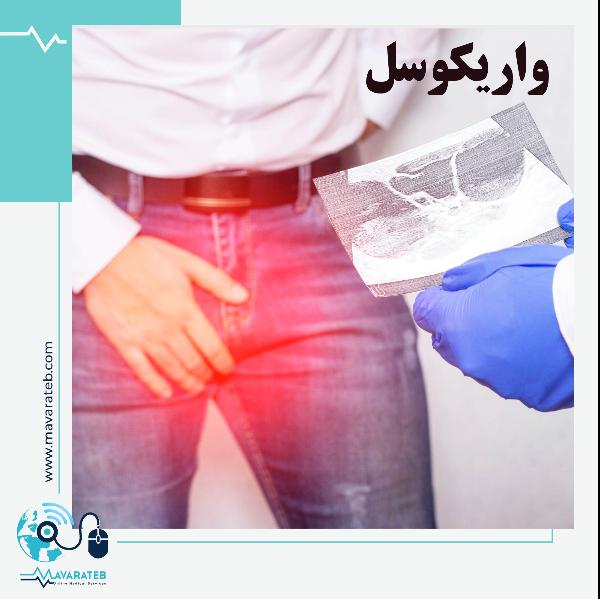 واریکوسل