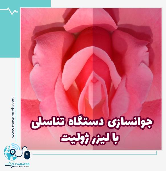 جوانسازی ناحیه تناسلی با لیزر ژولیت