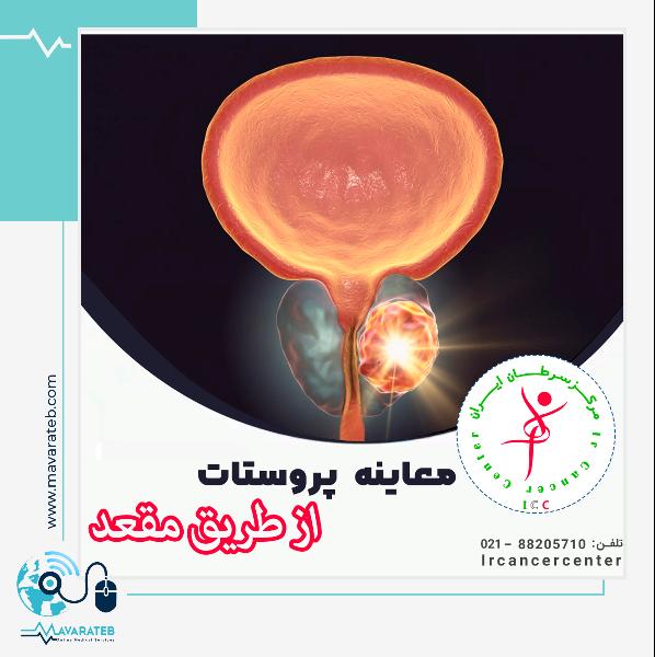 معاینه مقعدی پروستات