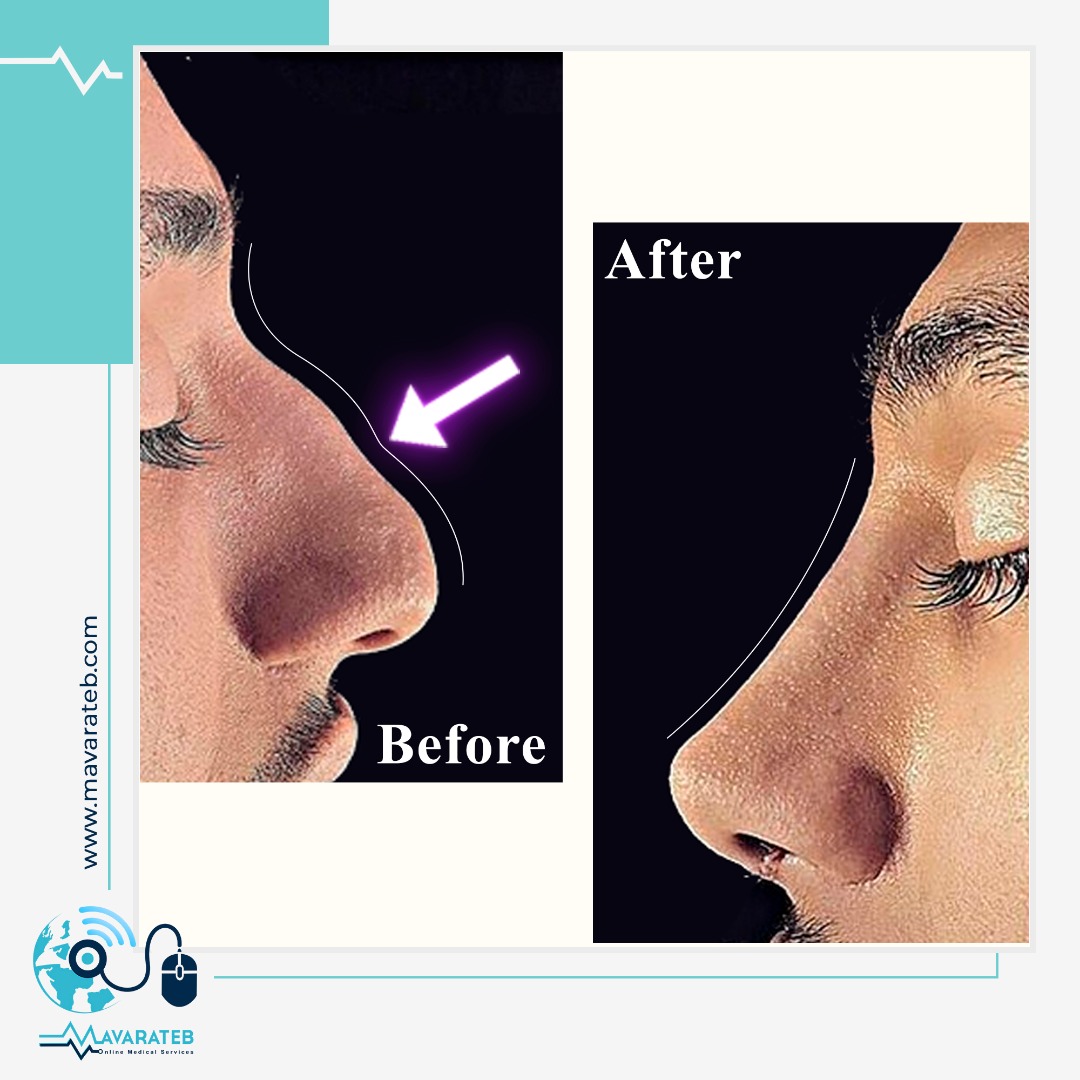 نمونه کار جراحی بینی دکتر شبنم شادابی