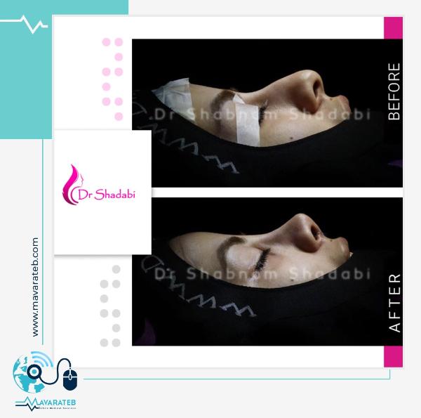 رفع ایرادات فاحش با جراحی بینی