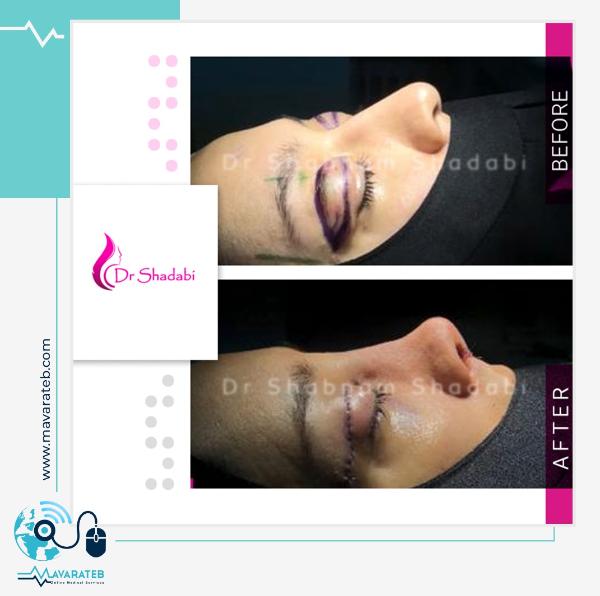 نمونه کار بلفاروپلاستی دکتر شبنم شادابی