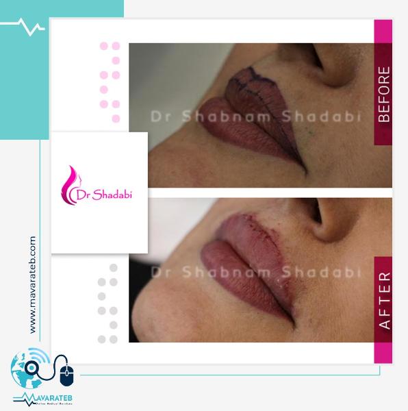 نمونه کار جراحی سانترال لب