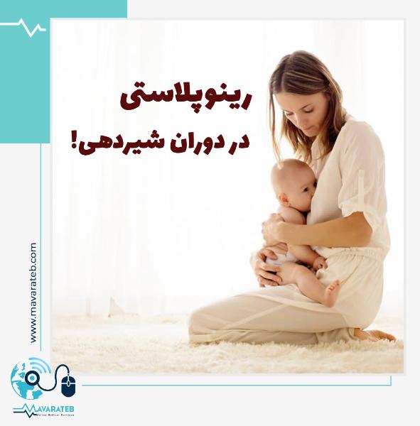 رینوپلاستی در دوران شیردهی