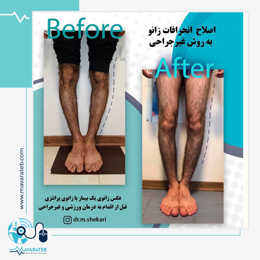 درمان زانوی پرانتزی بدون جراحی