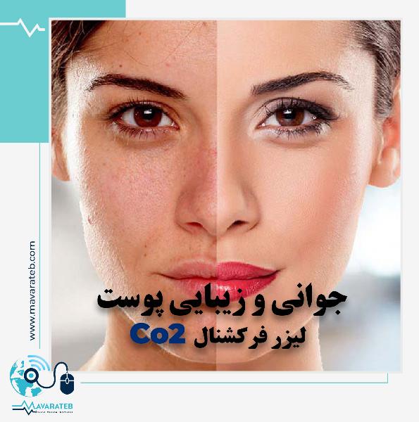 رمز جوانی با لیزر فرکشنال Co2