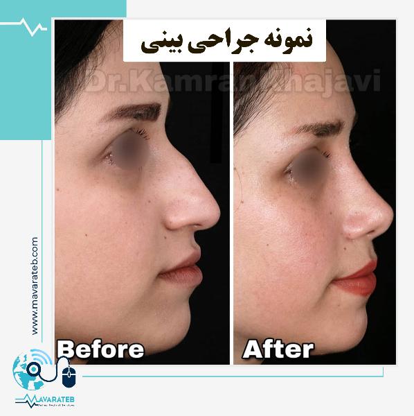 بلافاصله بعد از عمل زیبایی بینی