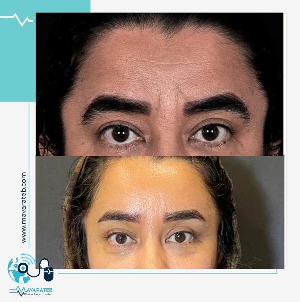 خطوط روی پیشانی