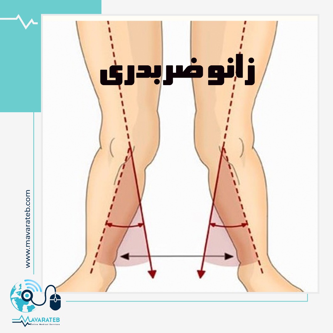 علت ایجاد زانوی ضربدری و راه درمان آن