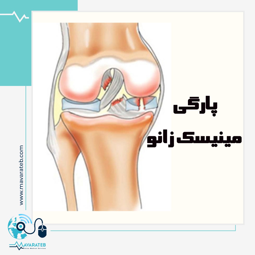 با پارگی منیسک زانو چه کنیم؟