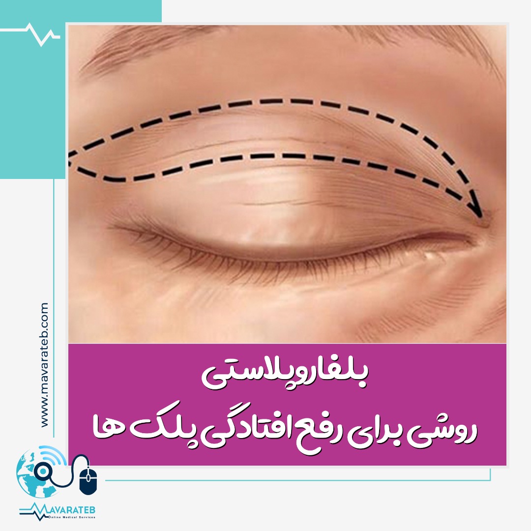 بلفاروپلاستی چگونه علائم پیری را می پوشاند؟