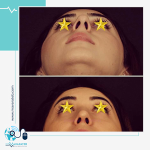 نمونه کار طبیعی جراحی بینی