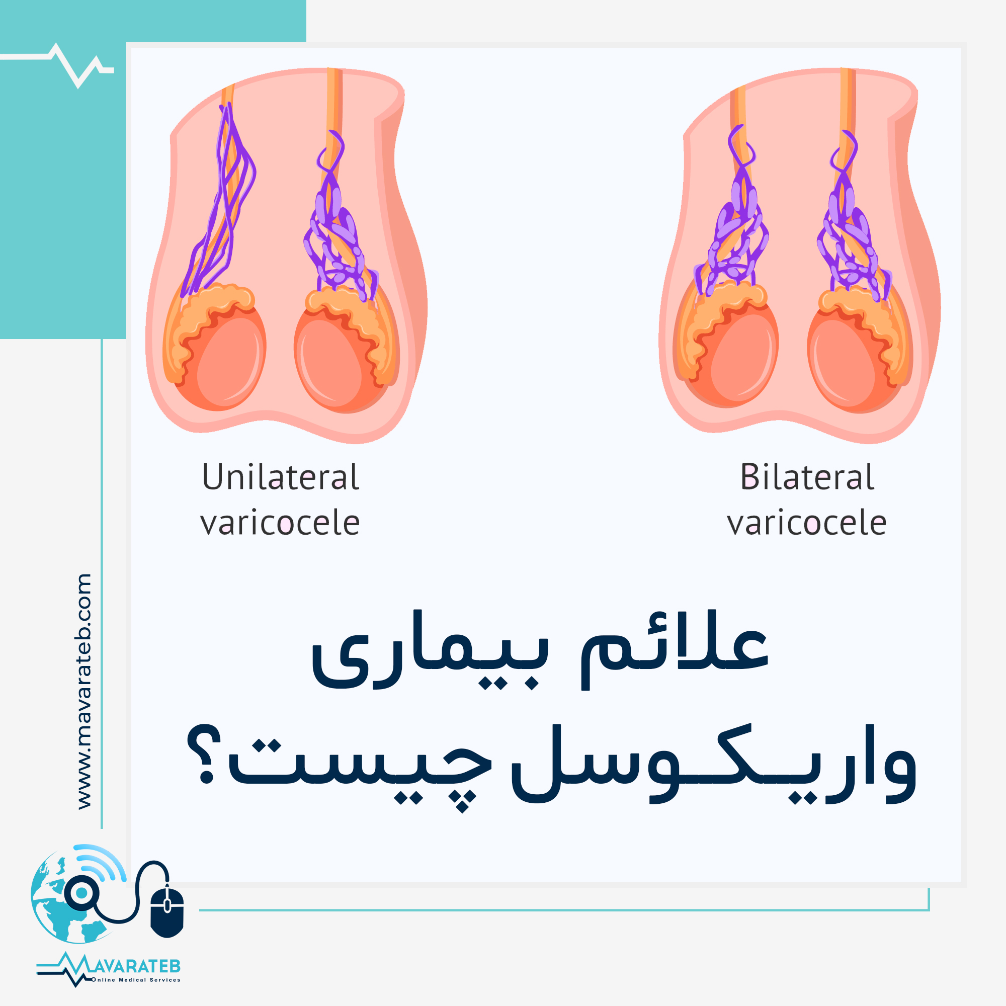 علائمی که خبر از ابتلا به واریکوسل می دهند!