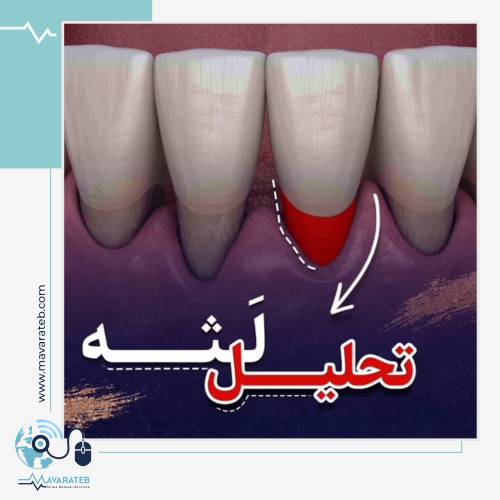 تحلیل لثه