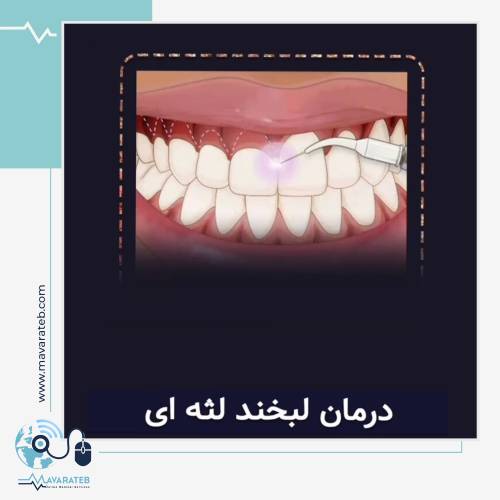 درمان لبخند لثه ای