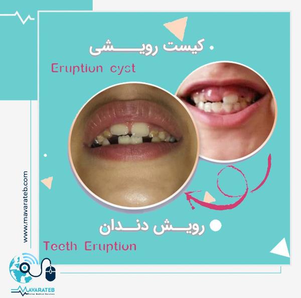 کیست رویشی دندان شیری