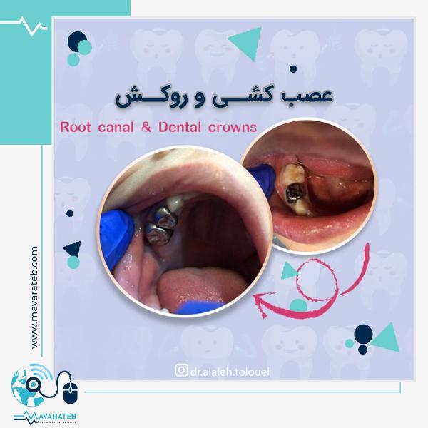 عصب کشی و روکش دندان کودکان