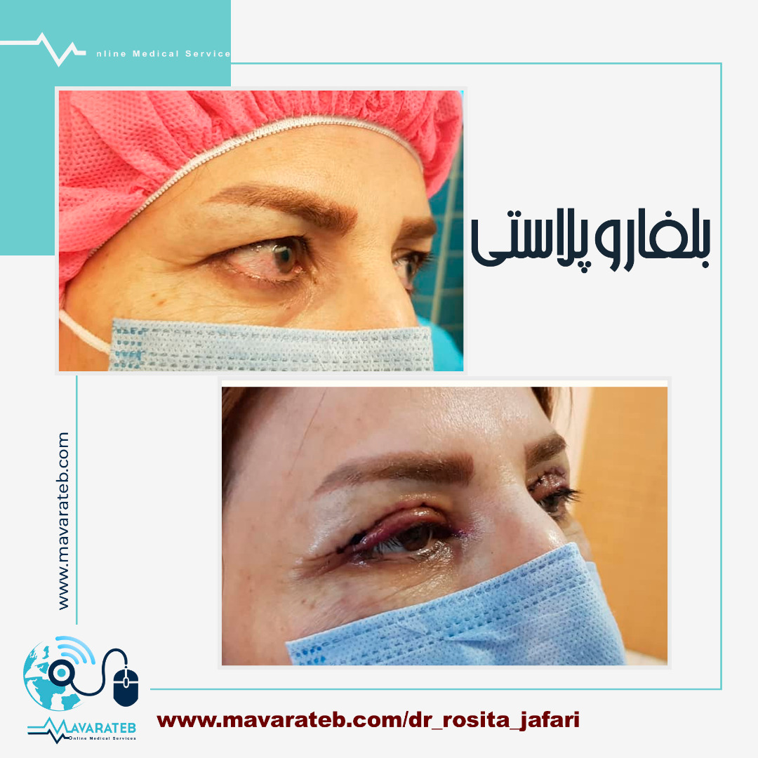 نمونه کار جراحی بلفاروپلاستی دکتر حمامی