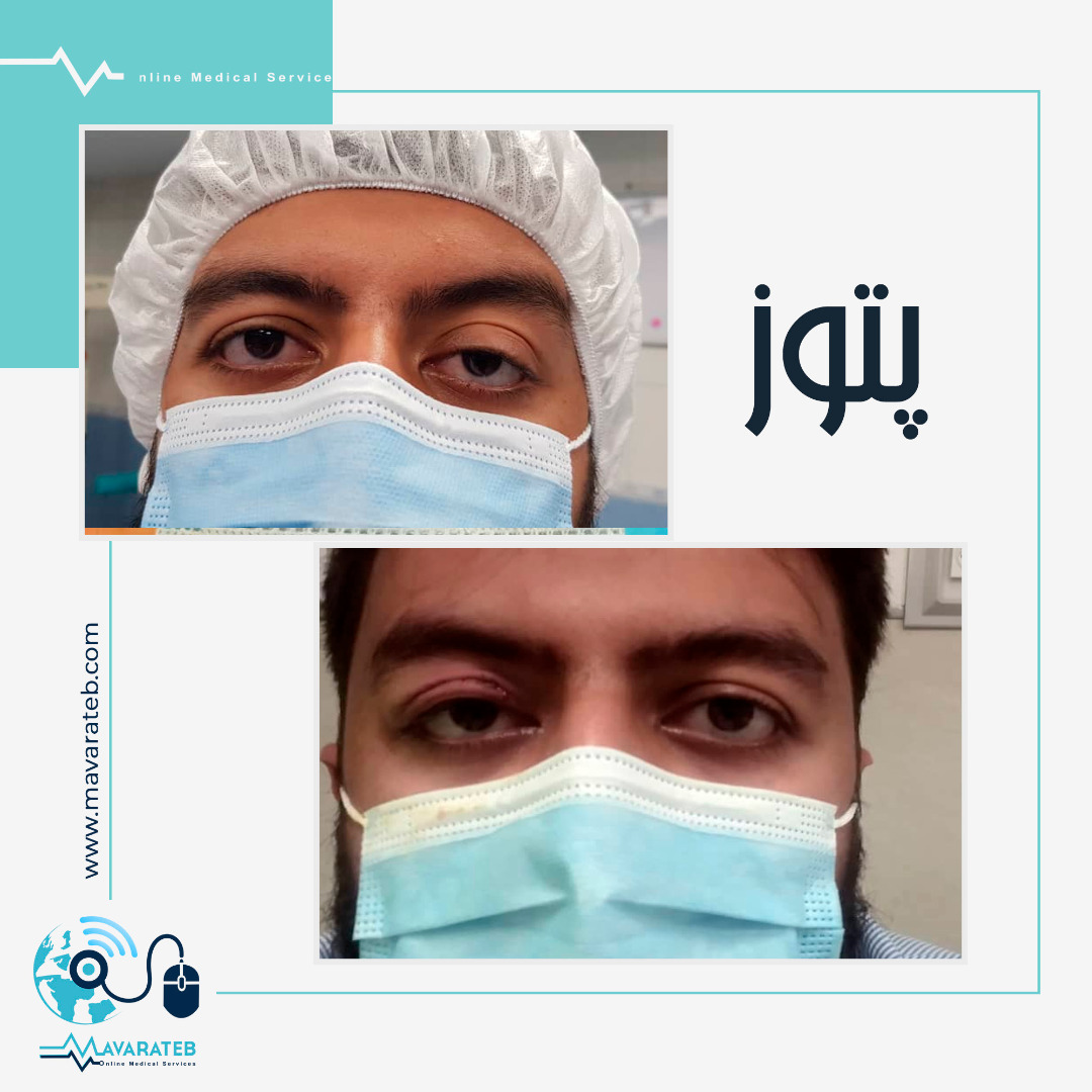 نتیجه نهایی عمل پتوز