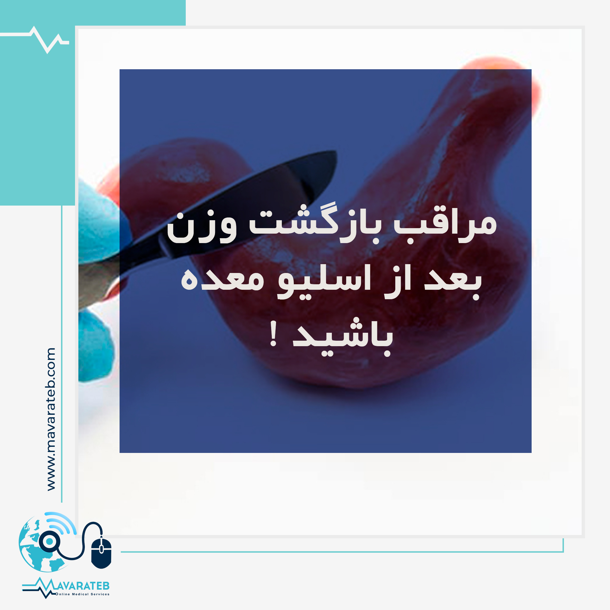 بازگشت وزن بعد از اسلیو معده!!!