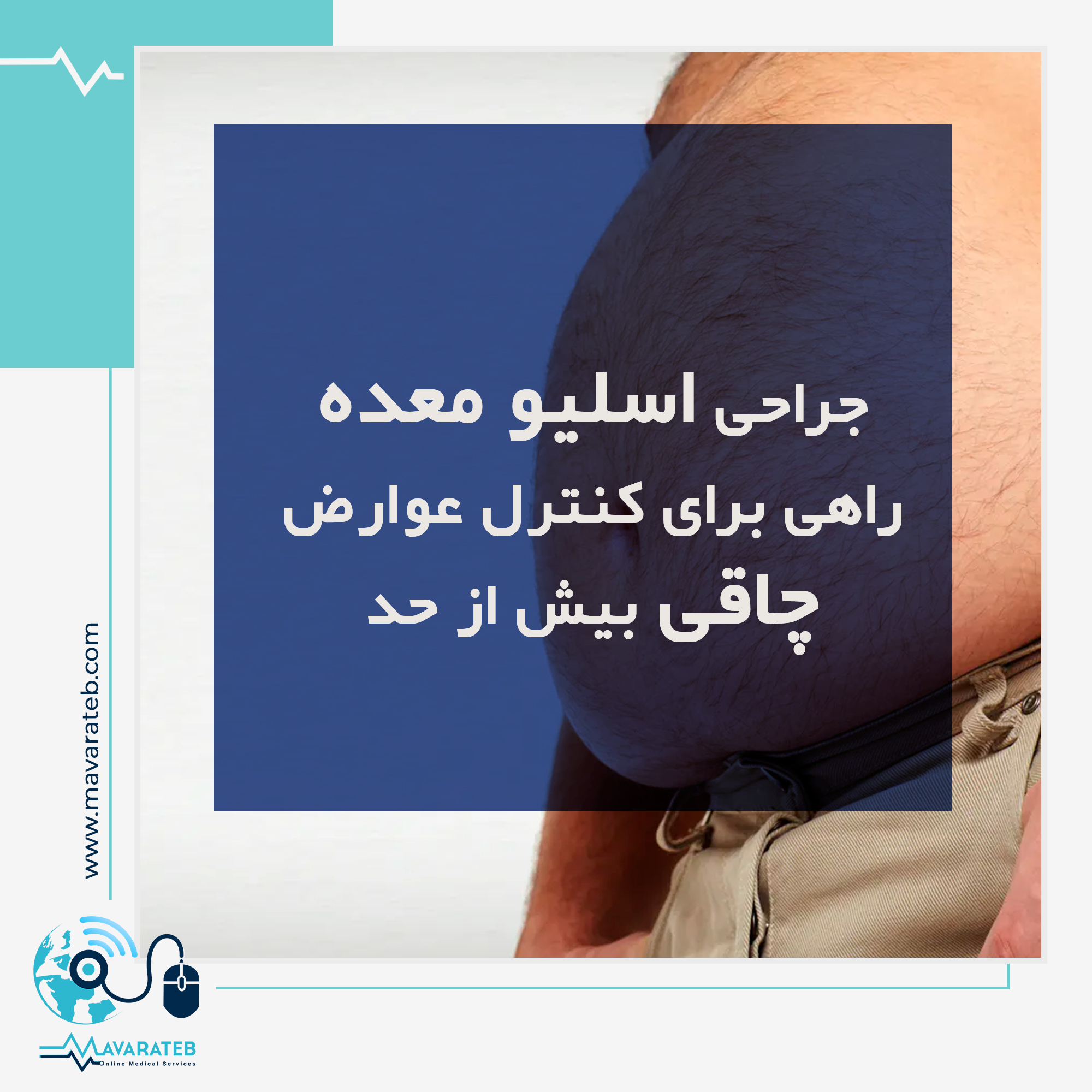 عمل اسلیو معده چه تاثیری در لاغری دارد؟