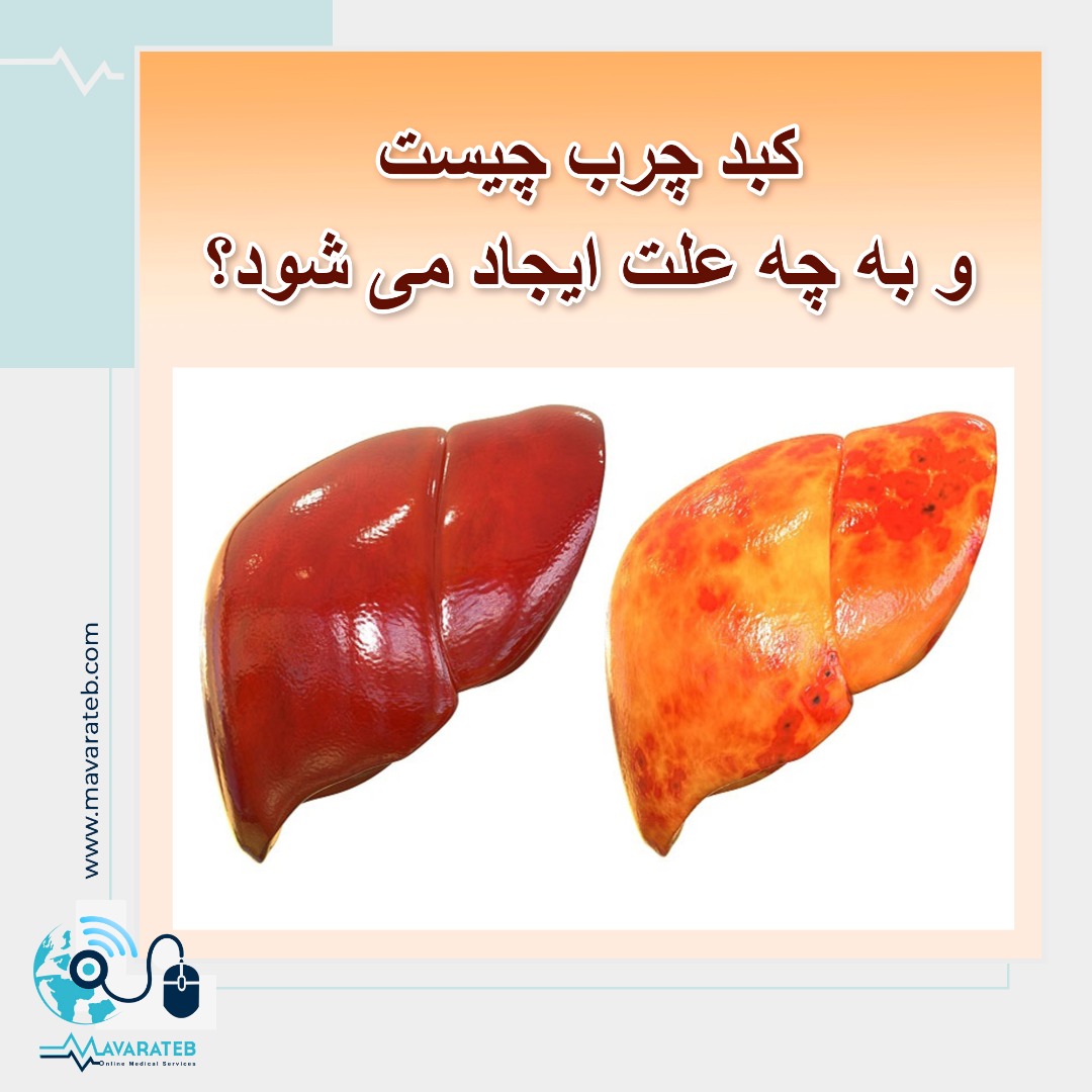 فاجعه ای به نام کبد چرب!!!!