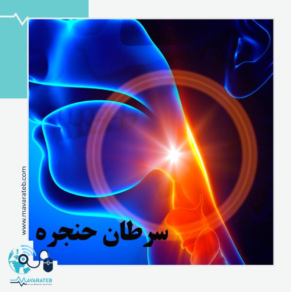 سرطان حنجره