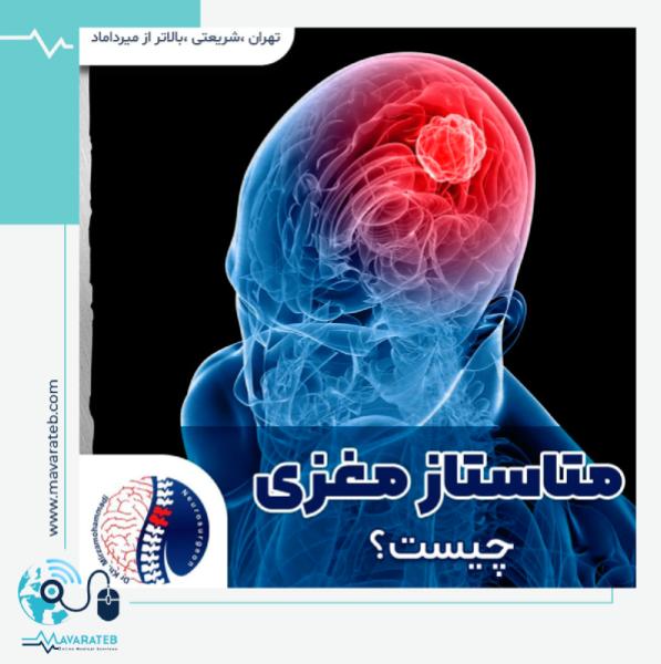 متاستاز مغزی؛ مرموز تر از سرطان!