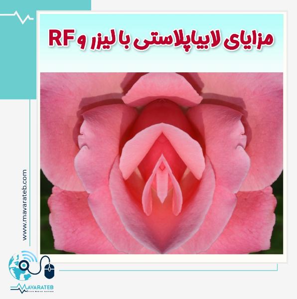 مزایای لابیاپلاستی با لیزر و آر اِف