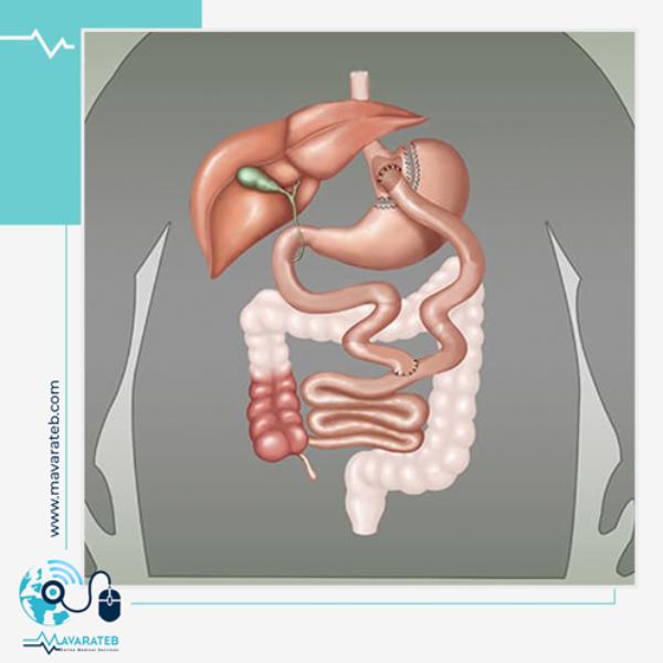 عمل بای پس معده