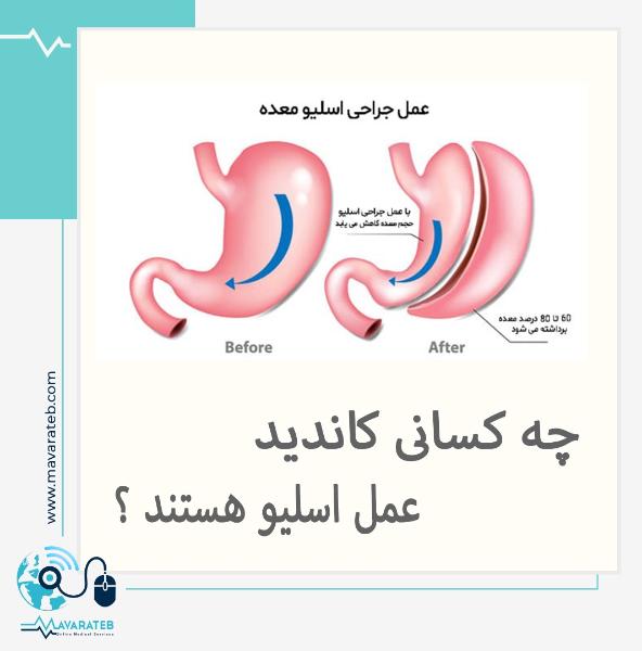 کاندیدای عمل اسلیو معده