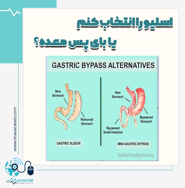 تفاوت جراحی اسلیو معده و جراحی بای پس