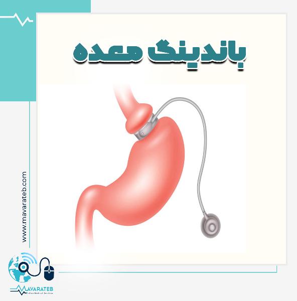 جراحی باندینگ معده