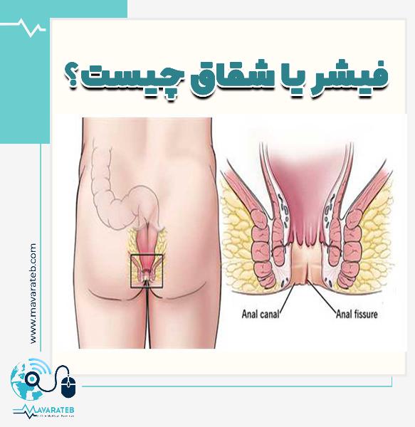 زخم مقعد نشانه چیست؟