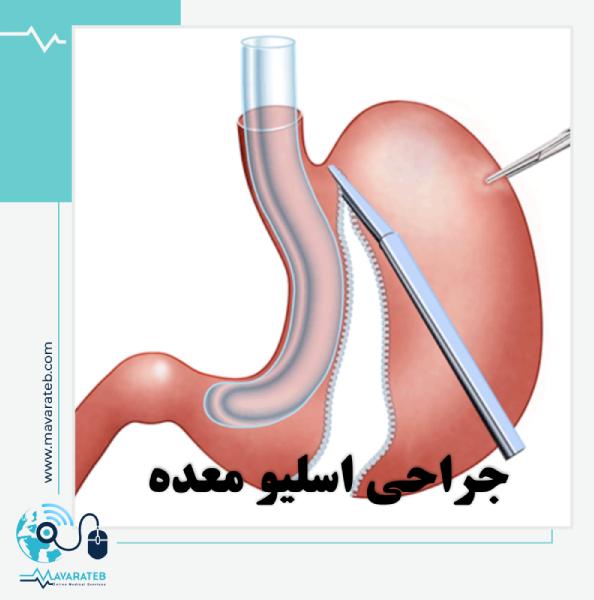 کاهش سریع وزن با اسلیو معده