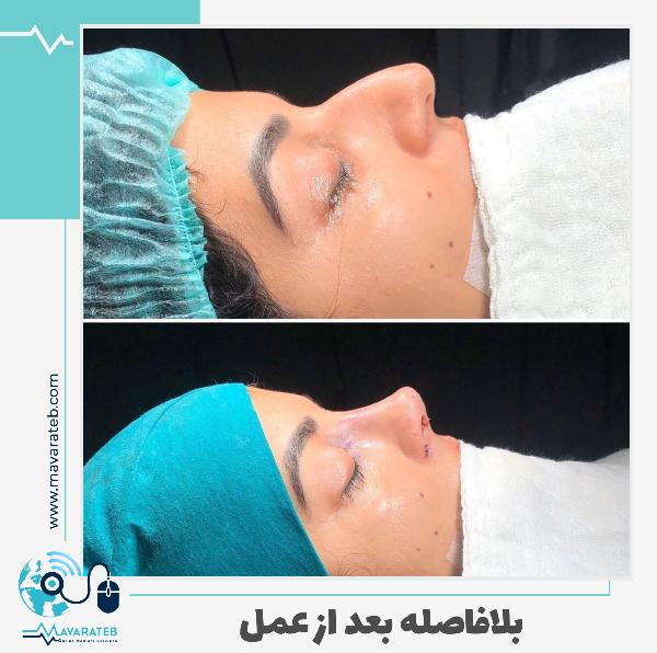 نمونه کار واقعی جراحی بینی