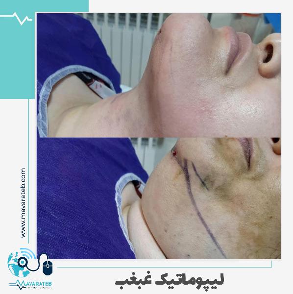 جراحی غبغب به شدت افتاده!!!