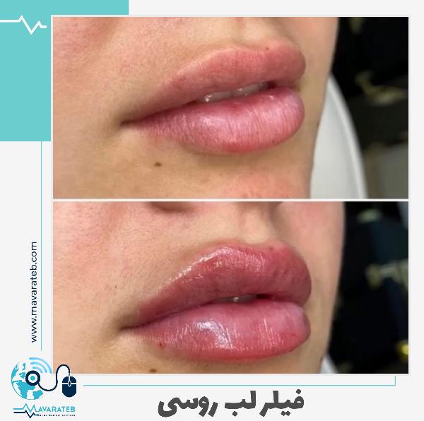 تزریق ژل لب روسی