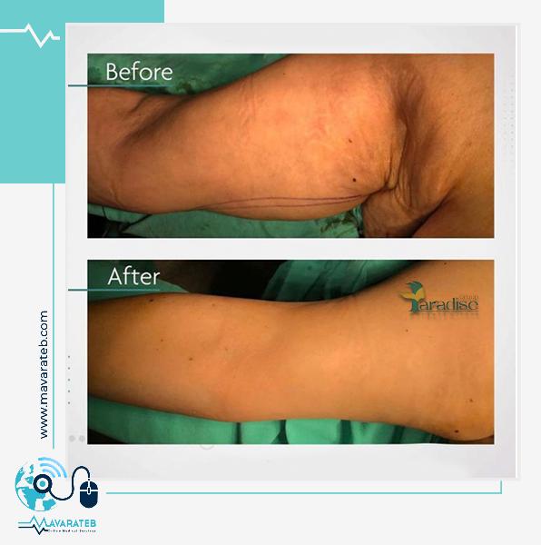 براکیوپلاستی