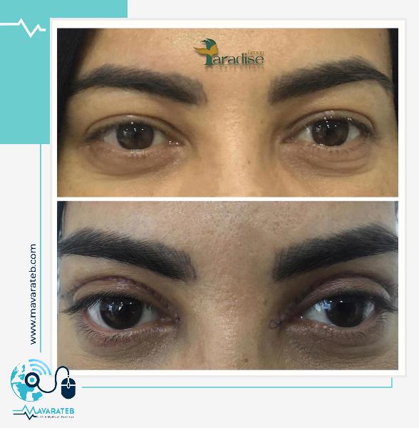 نمونه جراحی زیبایی پلک