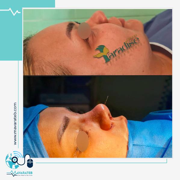 عکس بینی عمل شده بلافاصله بعد از جراحی