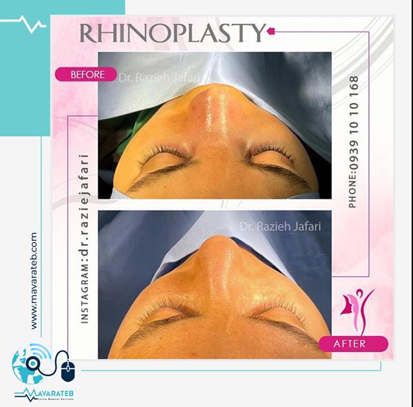 نمونه جراحی بینی بلافاصله بعد از عمل