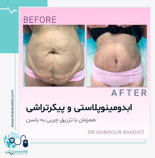 نمونه ابدومینوپلاستی