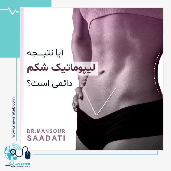 لیپوماتیک شکم