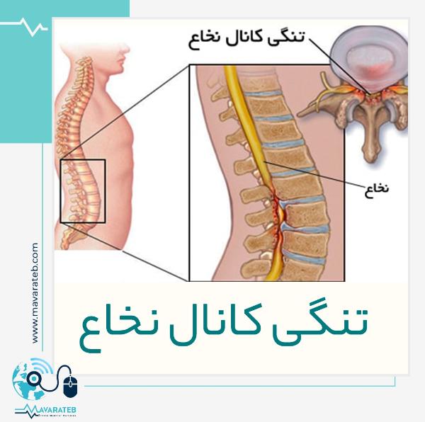 علائم تنگی کانال نخاعی و درمان سریع آن