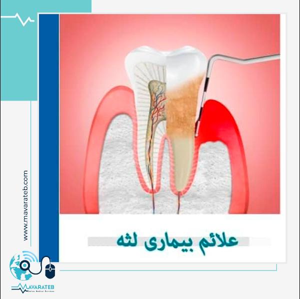 بیماری لثه و علائم آن