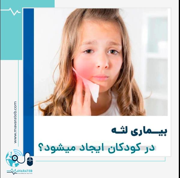 بیماری لثه در کودکان