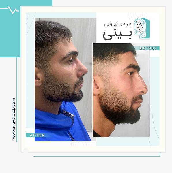 نمونه کار جراحی بینی مردانه